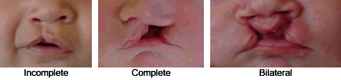 Cleft Types