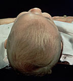 Coronal Craniosynostosis