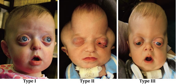Pfeiffer Syndrome