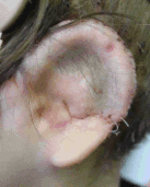 Ear After Second Stage