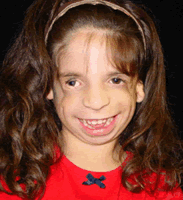 Treacher Collins Syndrome